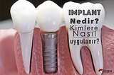 İmplant Nedir? Nasıl Uygulanır?