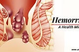Expert Answer | Everything About Hemorrhoids | AHM