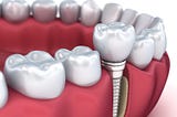 Dental Implants — What You Need to Know