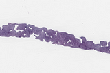 DLBCL, EBV-Positive