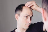 Hair loss, Hair loss in male, Hair loss in men