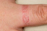 ECZEMA ( ATOPIC DERMATITIS):