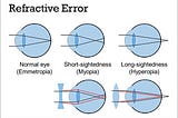 What are refractive errors in the eye?