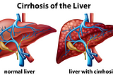 Cirrhosis of the Liver(Liver Cirrhosis) — Everything You Need to Know