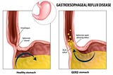 Medical writer explains a healthy stomach vs a GERD stomach