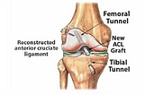 Revitalize Your Knee: Explore Orthocure’s Advanced Artificial ACL Replacement
