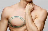 How is Gynecomastia Different from Chest Fat?