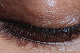 What Is Photosensitivity | Cause & Treatment | Skin Solution 1O1