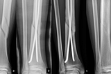 Effects of Weight-Bearing During Foot Fracture Healing