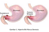 Hipertrofik Pilorus Stenosis