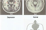 Figure 1: Depression is a Brain Injury. Excerpt from the book “Mental Illness is a Brain Injury” with the permission of the author, Mr. Takumi Tanabe.
