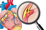 What’s Really Behind Clogged Arteries — Is Eating Cholesterol Really the Problem?