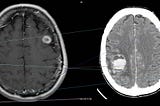 RoboDoc , using Machine Learning to detect brain tumors