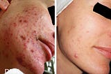 Causes, Symptoms, and Treatments of Cystic Acne