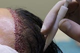 Is a Hair Transplant Painful?