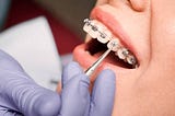 Transform Your Smile: Discovering the Best Braces in New York City