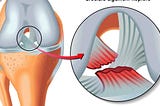 Save the ACL: Primary ACL Repair BACK TO THE FUTURE