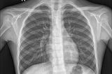 Chest X-ray Pneumonia Detection with Neural Networks