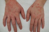 Atopic Dermatitis — Symptoms and Triggers