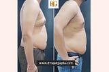 Common Side Effects and Risks of Gynecomastia Surgery