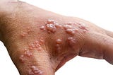 Monkeypox: Risk factors, severity and more