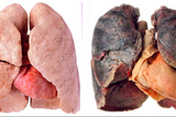 Black Lung Disease From Mining