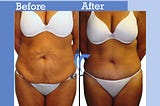 Get a Tummy Tuck Surgery and Say Goodbye to Your Belly Bulge