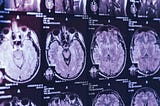 Doctors in Canada are perplexed by a mystery brain disease