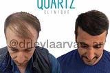 10 questions and 10 answers about Hair Transplantation in Istanbul!!!