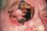 Click the link to know about Mucormycosis- the ‘black fungus’