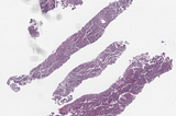 Benign Inflamatory Lymphadenopathy (EBV-Negative Infectious Mononucleosis-Like Lymphoproliferative…