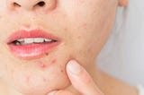 Frequently Asked Questions(FAQs) About Acne