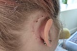 A picture of the back of head with the right ear visisble. There is a scar behind the right ear which looks to be healing