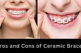 Ceramic Braces — Pros and Cons — Coolest Fact