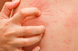 Hives Treatment: When to See Your Allergist