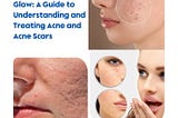 Unleash Your Inner Glow: A Guide to Understanding and Treating Acne and Acne Scars