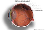Apakah Ablasio Retina Bisa di Sembuhkan