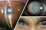 Your Eyes Age as You Age: Cataracts