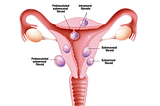 Uterine Fibroids: spreading awareness