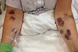 What I learned about COVID-19 from Acute Myeloid Leukemia