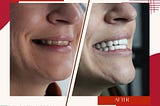 Rediscover Your Smile with Natural Tooth Color Restoration