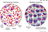 Myeloma Chronicles.. The Disease