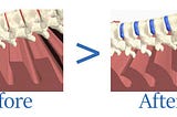 Spinal Traction Therapy with Lumbarest Back Traction Therapeutic Mat