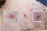 image of a man’s back with normal back air and three redlesions that look similar to a large spider bite with scabs