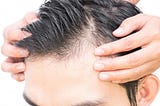 5 ways to cure baldness in Men