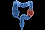 The Alarming Tide of Colorectal Cancer in Younger Adults