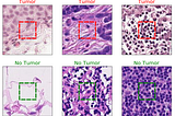 Convolutional Neural Network for Detecting Cancer Tumors in Microscopic Images