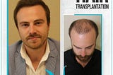 Hair Transplant Turkey