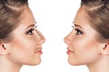 rhinoplasty procedures