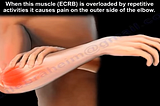 Common medical terminologies related to tennis elbow and their meanings.